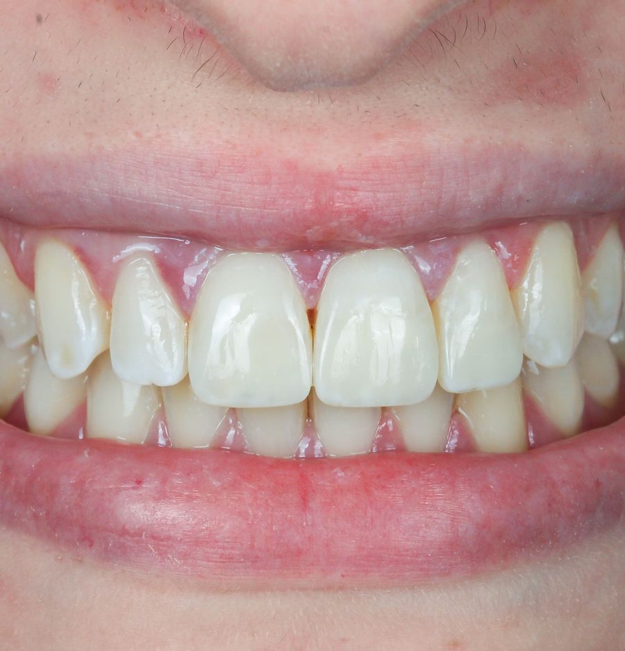 Chipped tooth After